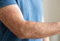 Contoh anggota tubuh yang terkena campak. (Foto: Istimewa)