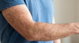 Contoh anggota tubuh yang terkena campak. (Foto: Istimewa)